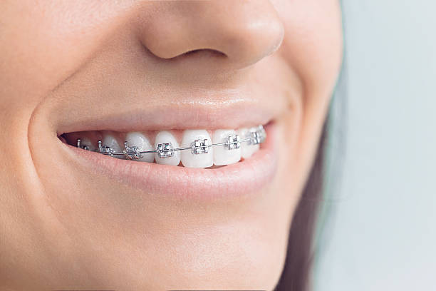 Best Invisalign and Clear Aligners  in Ben Lomond, CA